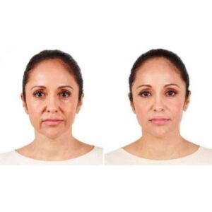 Alternative view of JUVEDERM ULTRA 4 (2x1ml)